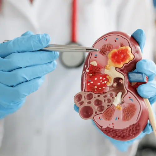 Glomerulonefritis: Diagnóstico y Tratamiento Especializado en CDMX