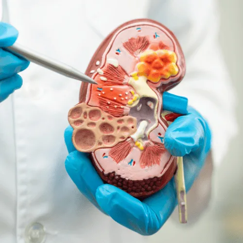 Nefropatía Diabética: Manejo Especializado para Preservar tu Función Renal en CDMX